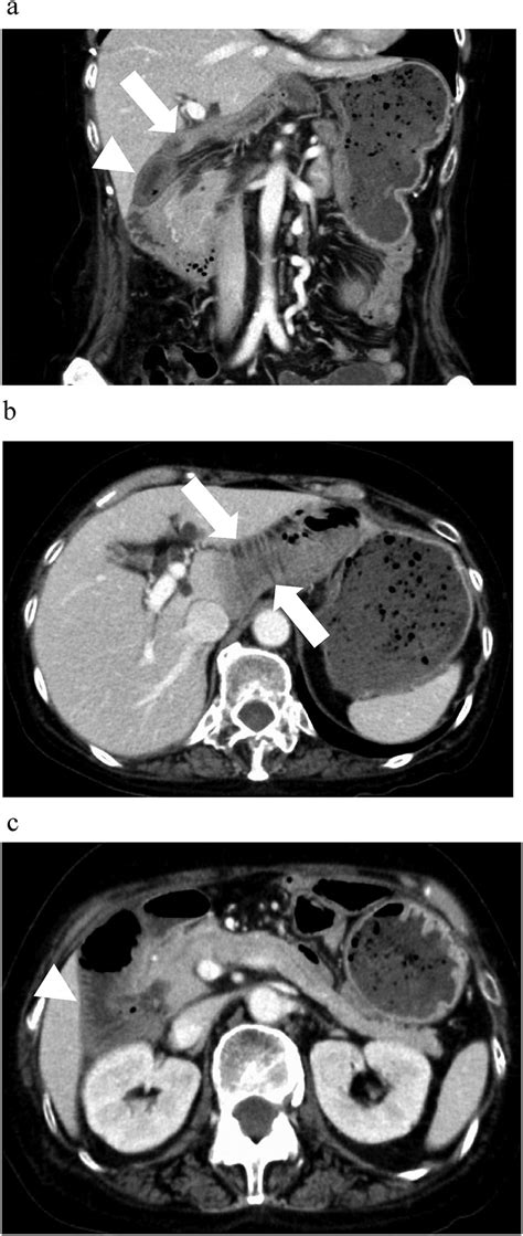 Abdominal Contrast Enhanced Ct Scans A B C The Small Intestine