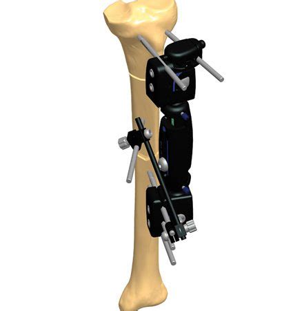 Tibia Bone Fracture Treatment Orthofix Abs