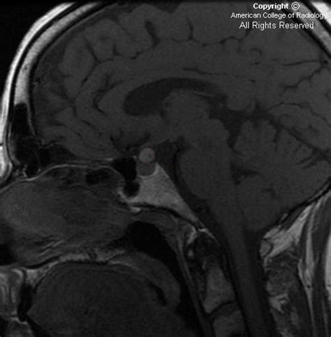 Neuroradiology On the Net: Rathke cleft cyst