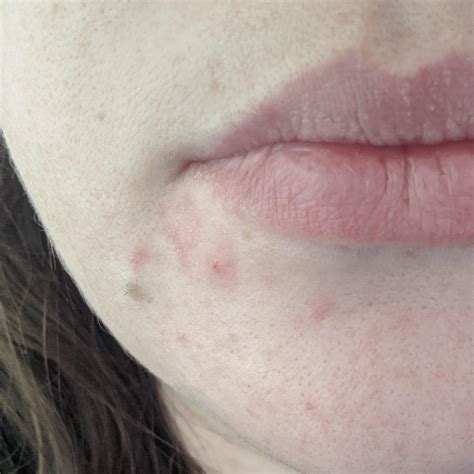 Can Someone Help Me Identify What I Believe Is Acne Around My Mouth R