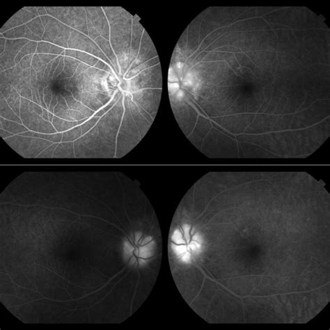 Fluorescein Angiography At Early Phase A And Late Phase B In 2012 Download Scientific