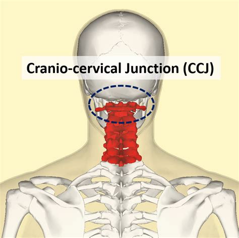 Alar Ligament Treatment For Ccj Instability Regenexx®