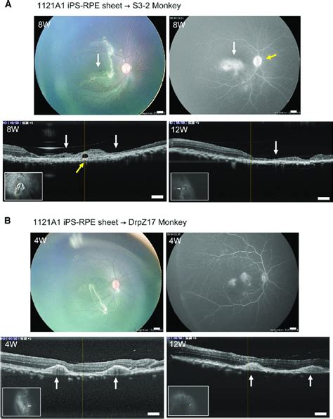 Allogeneic Transplantation Of Mhc Homozygote Ips Rpe Sheet Into