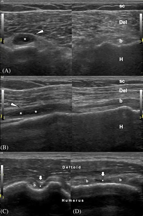 Dynamic Ultrasound Examination For Partial Biceps Tendon Rupture G K