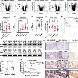 SPP1 Knockdown Impeded Tumor Progression In Human ESCA Cells With Or