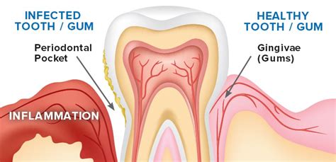 Bleeding Gum Dentist 3 Stages Of Periodontal Disease Know The Signs