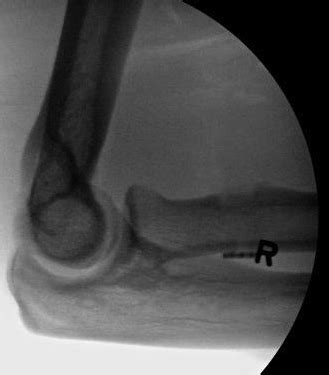 Distal Biceps Tendon Rupture The Bone School