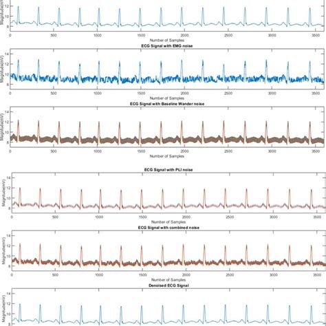 Original Ecg Signal Ecg Signal With Emg Noise Ecg Signal With