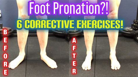 Flat Feetduck Feet” Foot Overpronation 6 Best Corrective Exercises