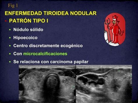 Enfermedad Tiroidea Nodular Patr N Tipo I