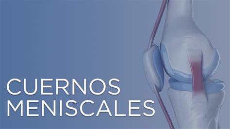 Tiempo de recuperación de la rotura del cuerno posterior del menisco