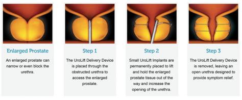 Urolift Treatment For Benign Prostatic Hyperplasia Bph Thayer