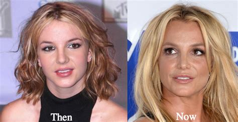 Britney Spears Plastic Surgery Before and After Photos