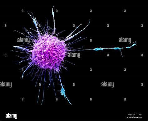 Cervical Cancer Cell Coloured Scanning Electron Micrograph Sem The