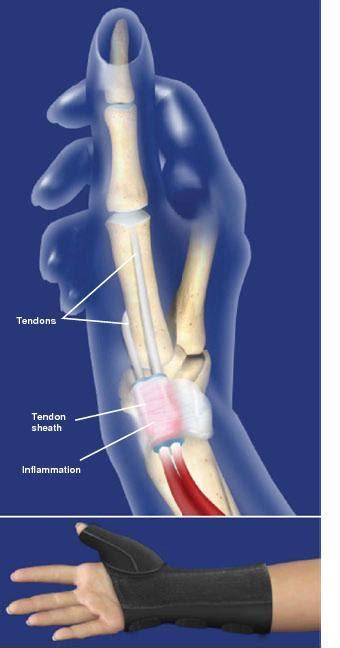 De Quervain's Tenosynovitis Surgery