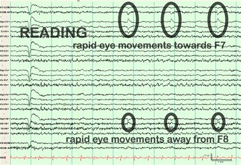 lateral eye movement