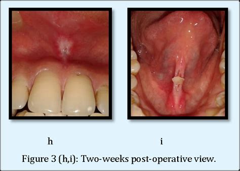 Figure From Management Of The Maxillary Labial Frenum And