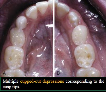 Oral Path Encironmental Alterations Of Teeth Flashcards Quizlet