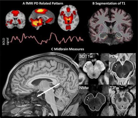 Magnetic Resonance Imaging In Parkinsons Disease A Representing Download Scientific Diagram