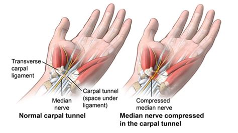 Median Nerve Carpal Tunnel