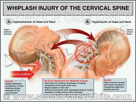 Muscle Involved In Whiplash