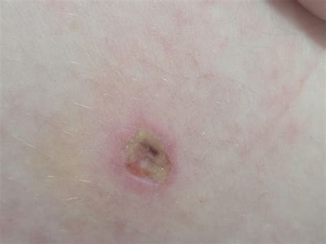 Biopsy wound healing? Does this look normal? Sorry for the close up ...