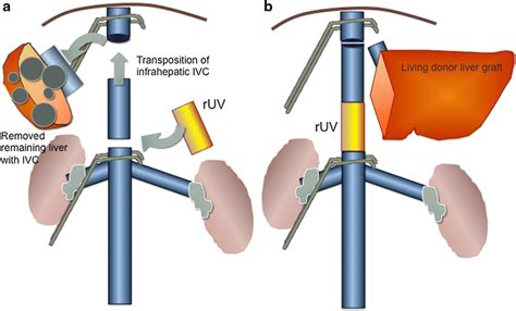 Hepatectomy With Hepatic Inferior Vena Cava IVC Resection Followed By