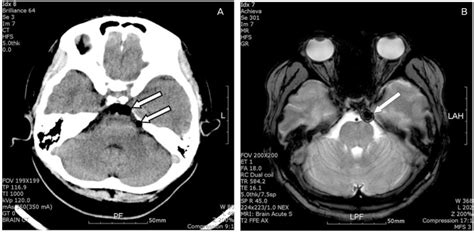 (A) Computed tomography just after the epidural blood patch procedure ...