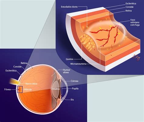 O Que Edema Macular Diab Tico Ioa Ioa