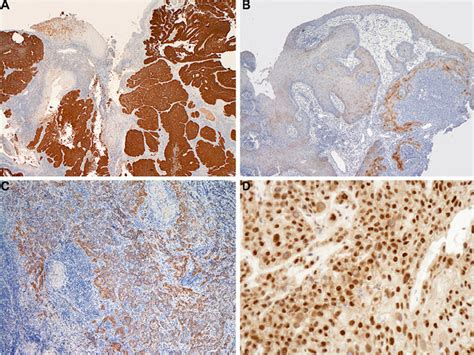 Diversity Of P16 Staining Patterns Strong Diffuse Nuclear And Download Scientific Diagram