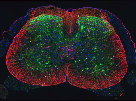 Base Editing Treats Spinal Muscular Atrophy In Mice Broad Institute