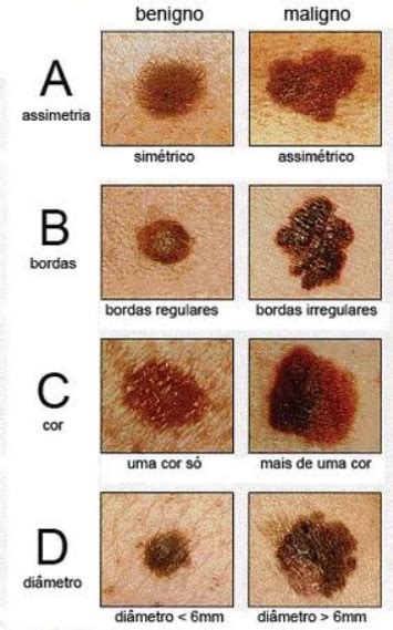 O Ano Laranja Conscientiza O Sobre O C Ncer De Pele Pronto