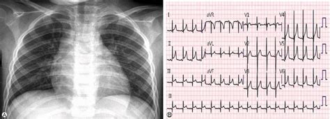 Chest Radiograph And Electrocardiography Of The Patient On Admission