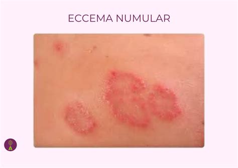 C Mo Diagnosticar La Dermatitis Lola Dermonutrici N