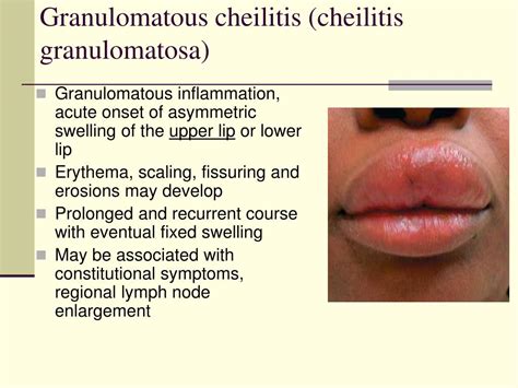 Ppt Diseases Of Oral Cavity Powerpoint Presentation Free Download