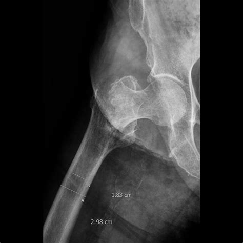 Intertrochanteric Fractures Core Em