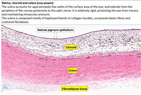 Eye Retina Choroid And Sclera Nus Pathweb Nus Pathweb