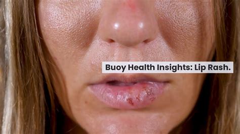 Lip Rash Common Causes And When To Seek Medical Care