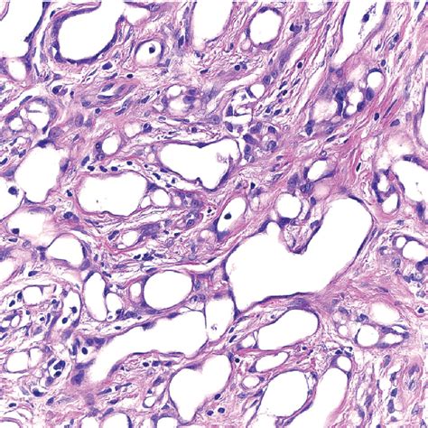 Figure 3 From Adenomatoid Tumor Of Testis Semantic Scholar