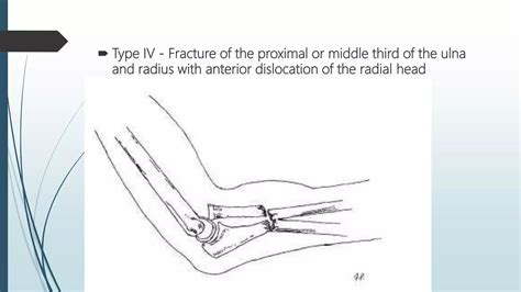 Fractures of radius and ulna . | PPT