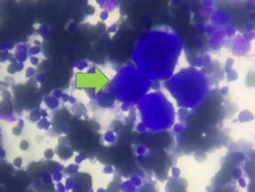 Patients Bone Marrow Aspiration Showing Megakaryocytes Green Arrow