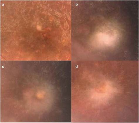 Full Article Punctate Inner Retinal Toxoplasmosis Case Series And