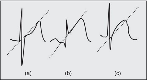 Electrocardiographic Differential Diagnosis of ST Segment Elevation | Anesthesia Key