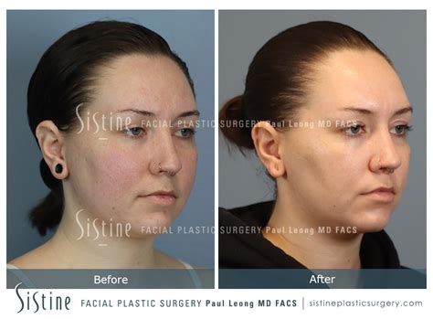 Buccal Fat Removal Before And After 01 Sistine Facial Plastic Surgery