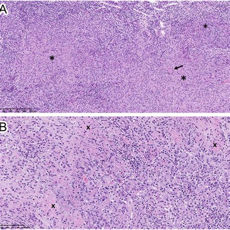 A And B Pathological Examination Of The Pituitary Biopsy Specimen