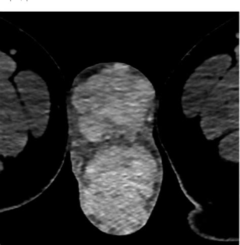 Testicular Adrenal Rest Tumours In An Adult Patient With Congenital