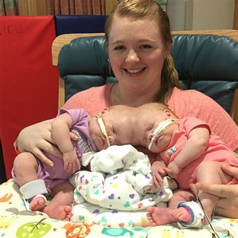 A Year In The Life Conjoined Twins Journey Abby And Erin Delaney Inspiring Love And