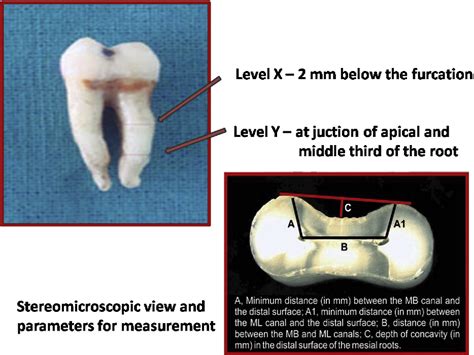 Correlation Of Root Dentin Thickness And Length Of Roots In Mesial