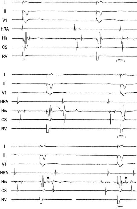 Atrioventricular Block What Is The Mechanism Heart Rhythm