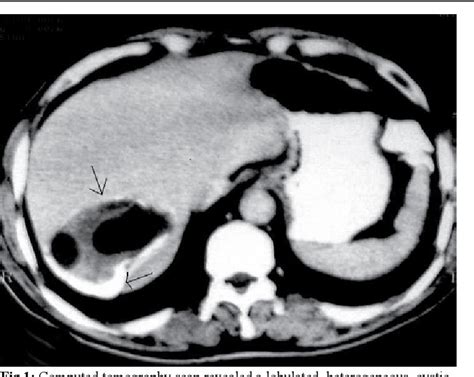 Figure 1 From Is Calcified Hydatid Cyst Absolutely Dead A Case Report And Review Of The